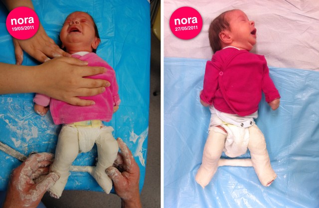 Nora gips 2 & 3